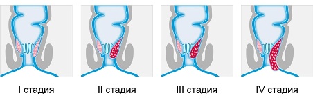 После беременности появился геморрой чем лечить thumbnail