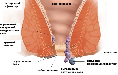 Схема геморроя