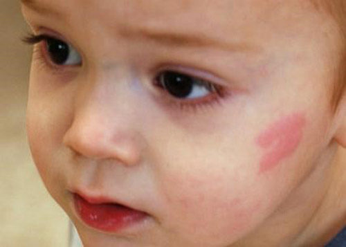 Ребенок покрылся красными пятнами - что это, и что помогает?